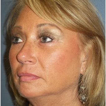 55-64 year old woman treated with Brow Lift after 3538877