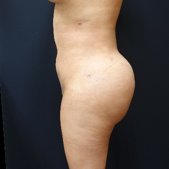 25-34 year old woman treated with Fat Transfer after 3286440
