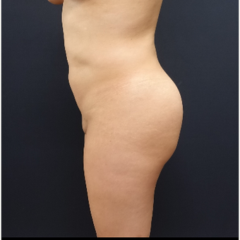 25-34 year old woman treated with Fat Transfer before 3286440