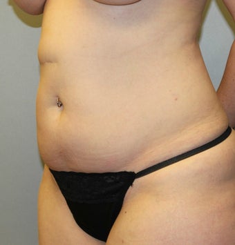35-44 year old woman treated with Liposuction before 3589587