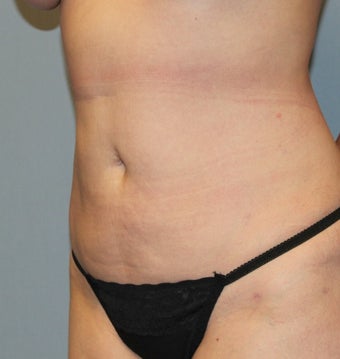 35-44 year old woman treated with Liposuction after 3589587