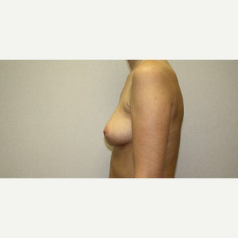 25-34 year old woman treated with Breast Augmentation 1815599