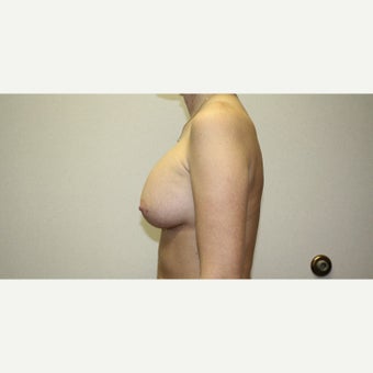 25-34 year old woman treated with Breast Augmentation 1815599