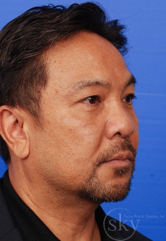55-64 yo gentleman 1 month s/p transconjunctival lower lid blepharoplasty after 2834480