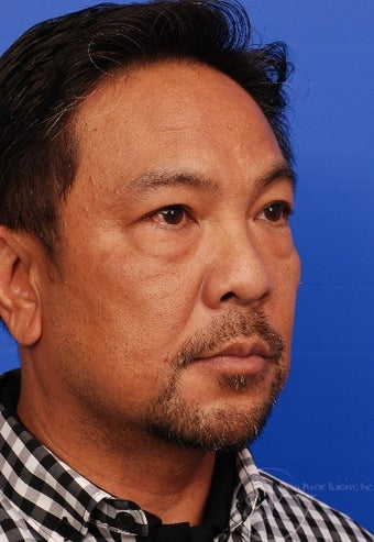55-64 yo gentleman 1 month s/p transconjunctival lower lid blepharoplasty before 2834480