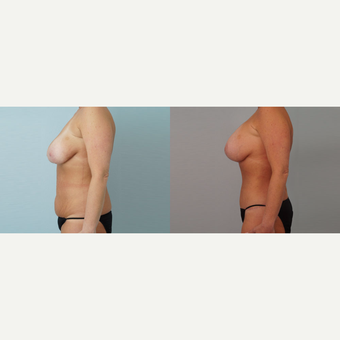 35-44 year old woman treated with Mommy Makeover after 3099723