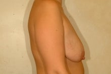 Full-Mastopexy Augment before 151273