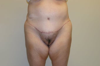 Massive Weight Loss Plastic Surgery after 594030