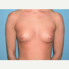 25-34 year old woman treated with Breast Augmentation before 3743304