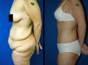 28 Year Old Woman - Body Contouring after 1104568