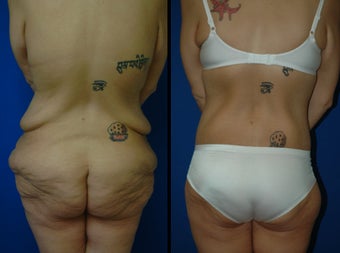 28 Year Old Woman - Body Contouring 1104568