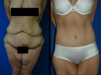28 Year Old Woman - Body Contouring before 1104568
