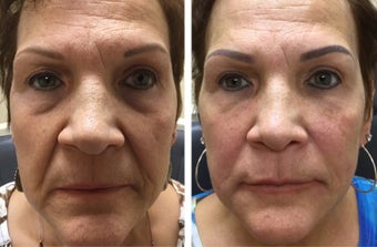 65-74 year old woman treated with Bellafill before 3367430