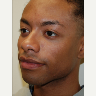 25-34 year old man treated with Silikon 1000 for permanent cheek augmentation after 3487865