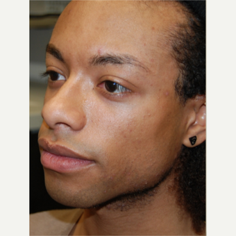 25-34 year old man treated with Silikon 1000 for permanent cheek augmentation before 3487865