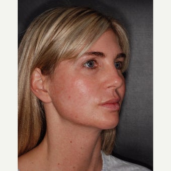 35-44 year old woman treated with CO2 Laser before 2454503