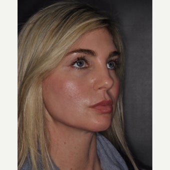 35-44 year old woman treated with CO2 Laser after 2454503