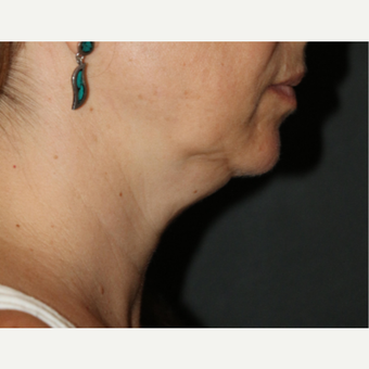 35-44 year old man treated with CoolSculpting before 3684111