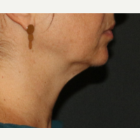 35-44 year old man treated with CoolSculpting after 3684111