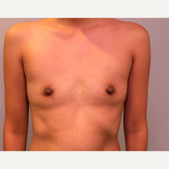 35-44 year old woman treated with Breast Augmentation before 3725884