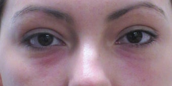 Before and after lower eyelid and cheek fillers after 3422852