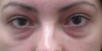 Before and after lower eyelid and cheek fillers before 3422852