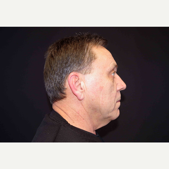 55-64 year old man treated with Fat Transfer and Direct Neck Lift before 3439298