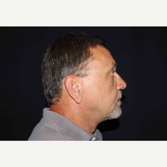 55-64 year old man treated with Fat Transfer and Direct Neck Lift after 3439298