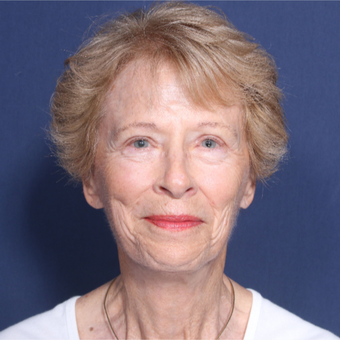 65-74 year old woman treated with Neck Lift (view 1 of 2) after 3179870