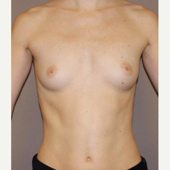25-34 year old woman treated with Breast Augmentation before 3482950