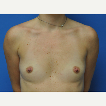 30 year old woman treated with Breast Augmentation to go from 34A to 34C before 2751480