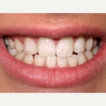 18-24 year old woman treated with Dental Bonding after 2044787