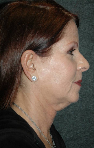 Late 50's woman treated with facelift before 887984