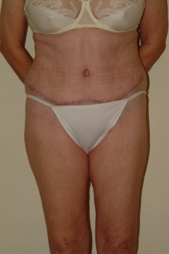 66 yr old lady with lax abdomen after 1095995