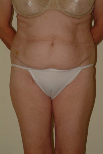 66 yr old lady with lax abdomen before 1095995