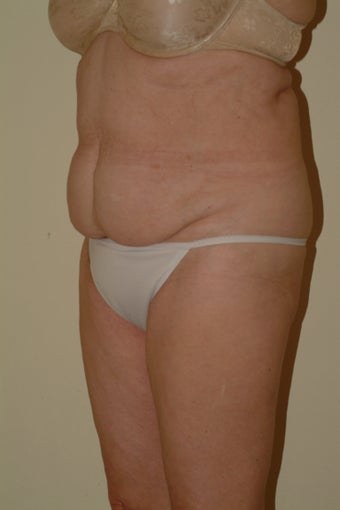 66 yr old lady with lax abdomen 1095995