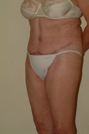 66 yr old lady with lax abdomen 1095995