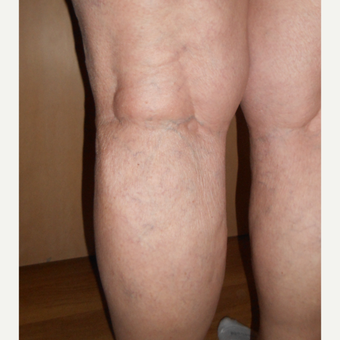 65-74 year old woman treated with Sclerotherapy after 3161471