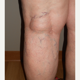 65-74 year old woman treated with Sclerotherapy before 3161471