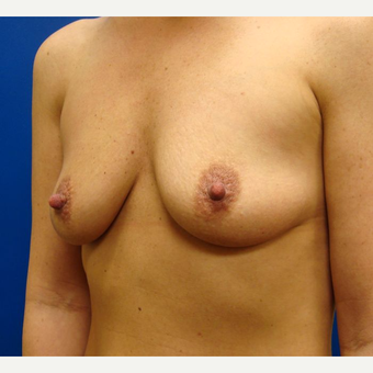 25-34 year old woman treated with Breast Implants before 3670302