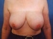 48 year old female patient before 934567