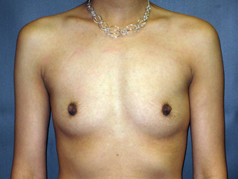 Silicone Breast Augmentation before 330775