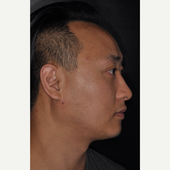 35-44 year old man treated with Septoplasty 8 months post-op after 3500030