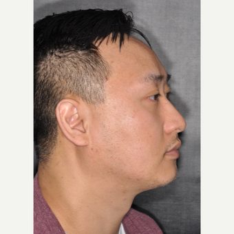 35-44 year old man treated with Septoplasty 8 months post-op before 3500030