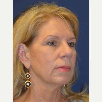 55-64 year old woman treated with Facelift before 3370662