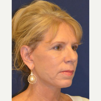 55-64 year old woman treated with Facelift after 3370662