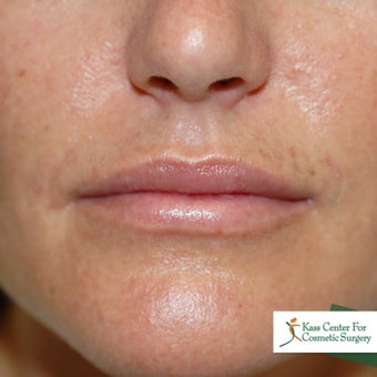Perma Facial Implant after 340186