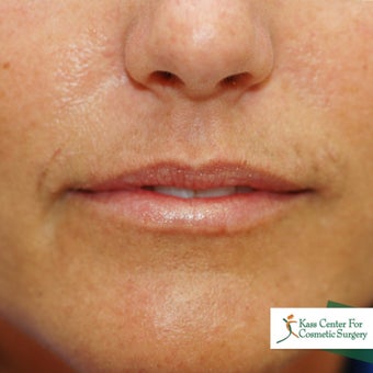 Perma Facial Implant before 340186