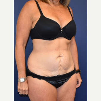 45-54 year old woman treated with Liposuction before 3744528