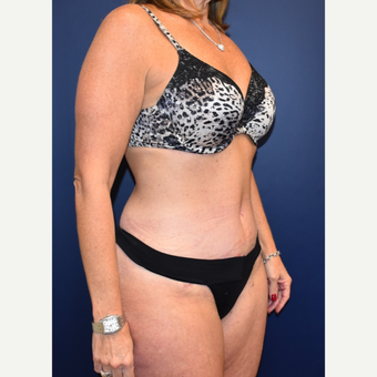 45-54 year old woman treated with Liposuction after 3744528